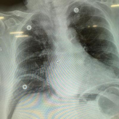Pneumopéritoine